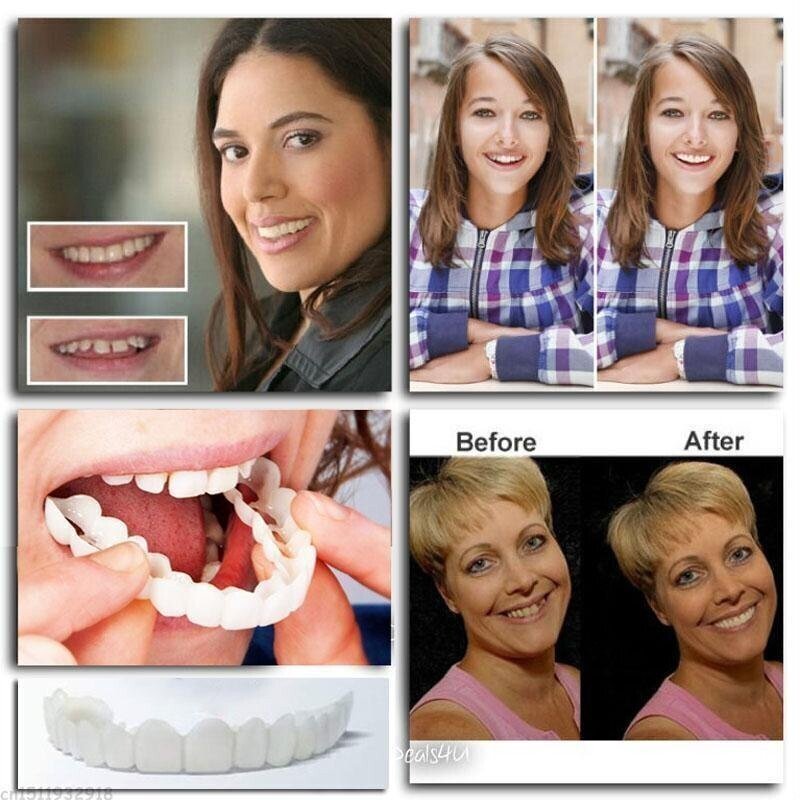 Kalsten | Adjustable Snap-On Dentures