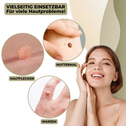 Skanto | DermaLinx Wart Remover | Pain-Free Removal of Warts and Moles | For Home Use | No Surgery