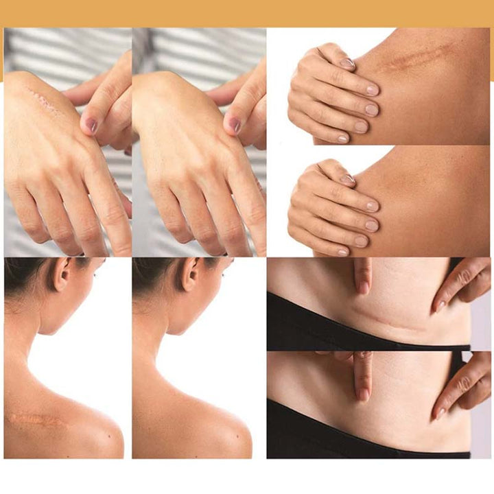 Kalsten | Skin Invisible Concealer Patch