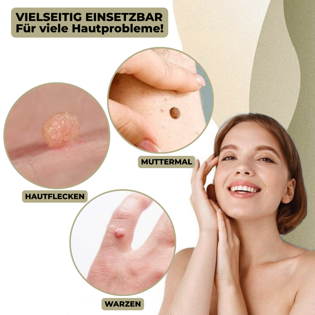 Kalsten | DermaLinx Wart Remover | Pain-Free Removal of Warts & Moles | For Home | Without Surgery