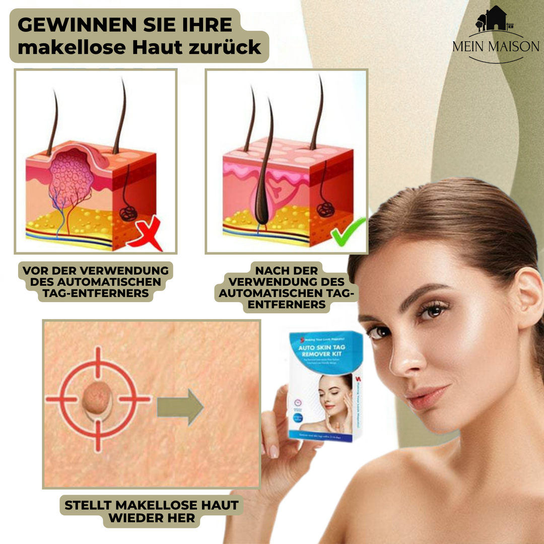 Kalsten | DermaLinx Wart Remover | Pain-Free Removal of Warts & Moles | For Home | Without Surgery