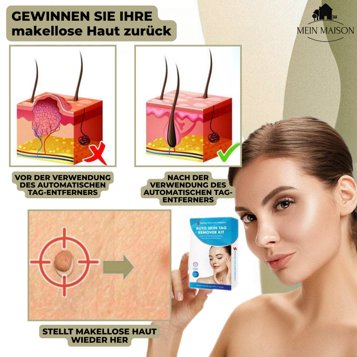 Kalsten | DermaLinx Wart Remover | Pain-Free Removal of Warts & Moles | For Home | Without Surgery