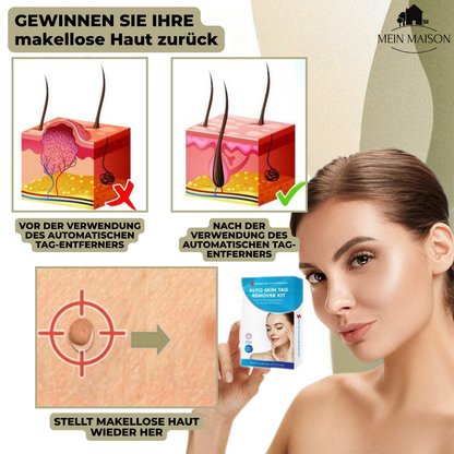 Skanto | DermaLinx Wart Remover | Pain-Free Removal of Warts and Moles | For Home Use | No Surgery