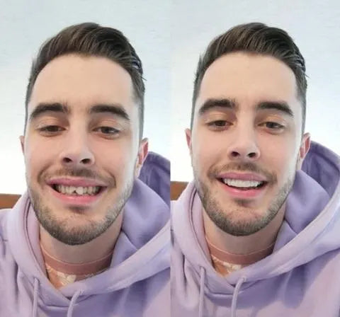 Kalsten | On Smile Veneers (Upper and Lower Jaw included)