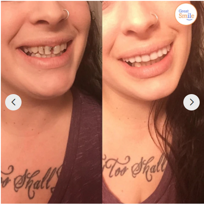 Snap-in Denture | 1+1 FREE!