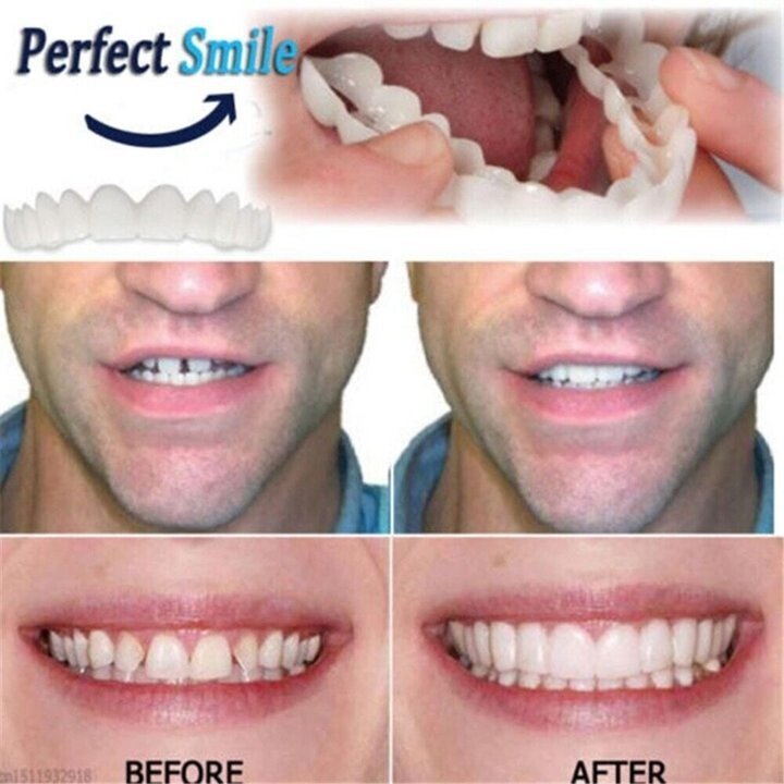 Kalsten | Adjustable Snap-On Dentures