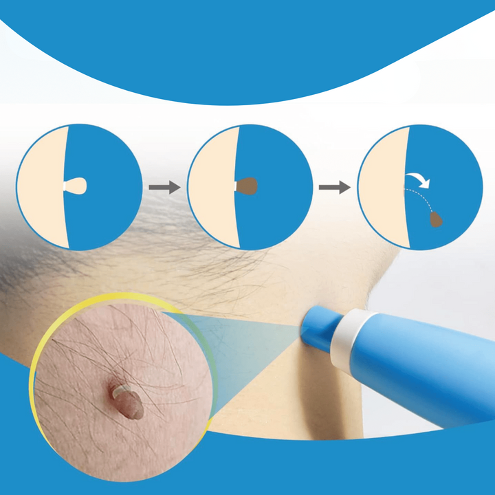 Kalsten | WartAway – Natural Wart Remover