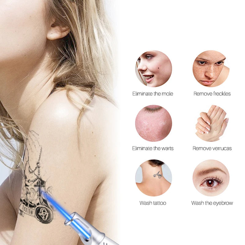 Kalsten | Smart Tattoo Removal Laser Pen - Remove moles, freckles, acne, tattoos