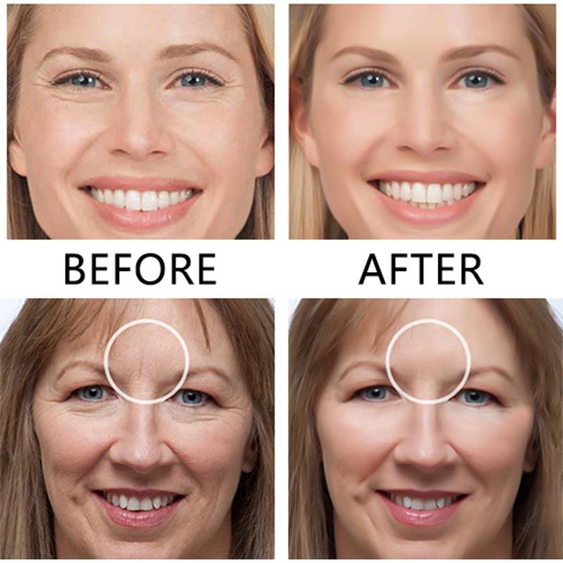 Kalsten | Face Nutrition Wrinkle Removal Lift Stickers