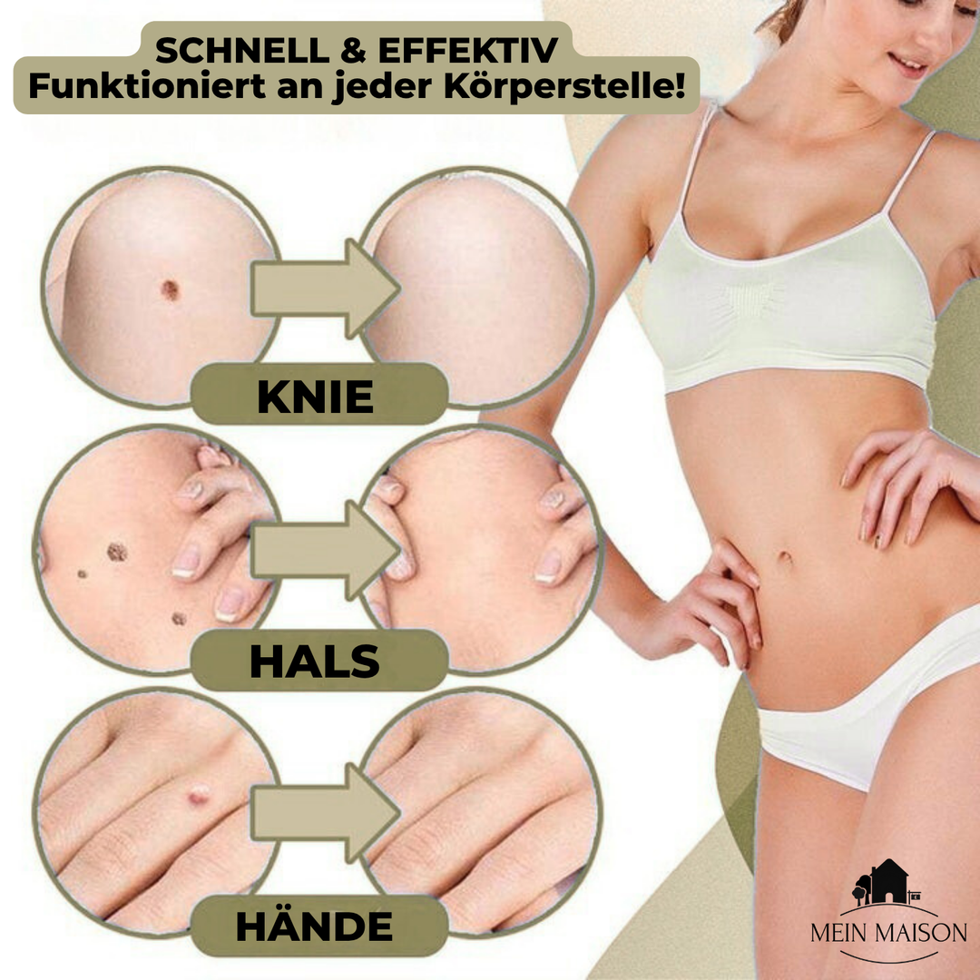 Kalsten | DermaLinx Wart Remover | Pain-Free Removal of Warts & Moles | For Home | Without Surgery