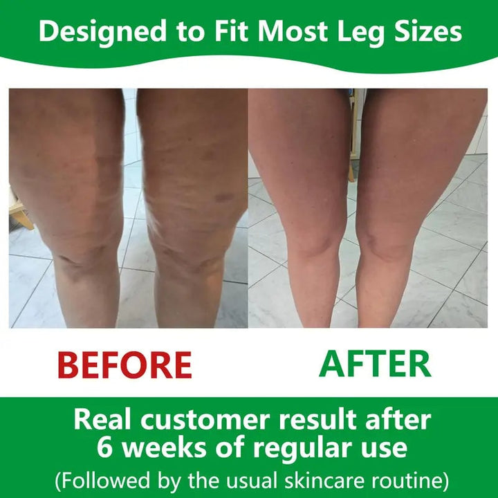 Kalsten | Sakerplus Cellulite Massage Roller