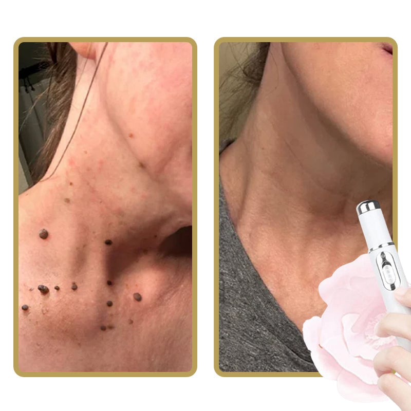Kalsten | ClearDerm - Quick, painless pimple removal for smooth, clear skin