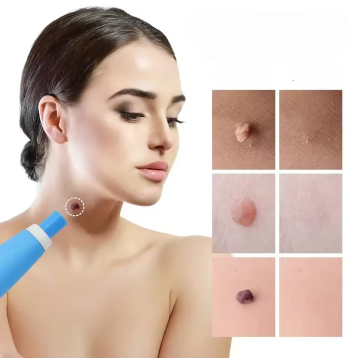 Kalsten | WartAway – Natural Wart Remover