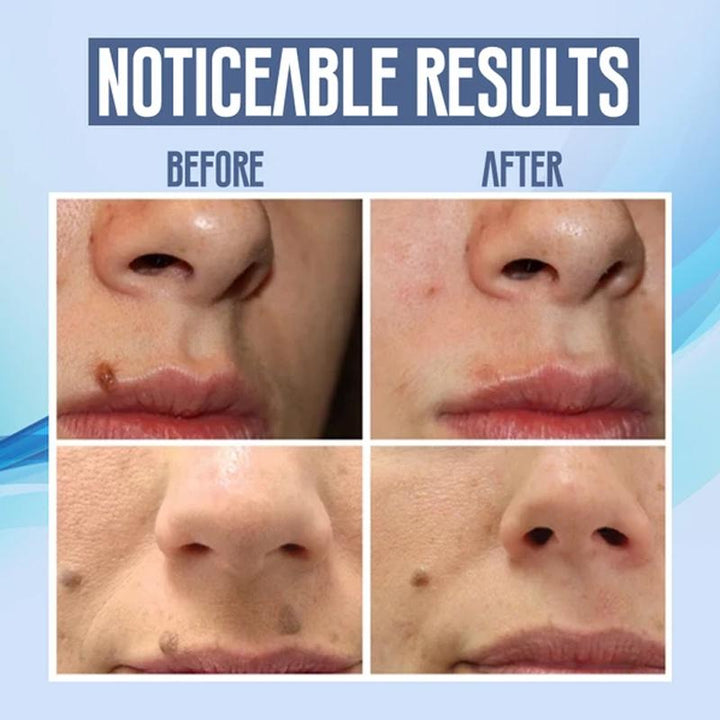 Kalsten | Facial Hair Removal Pen