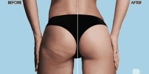 Anti Cellulite Vacuum Silicone Cups | Kalsten