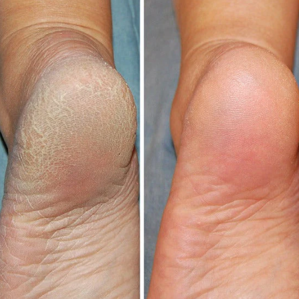 Kalsten | Silicon-Spa-Socks - Intensive care for cracked and tired feet
