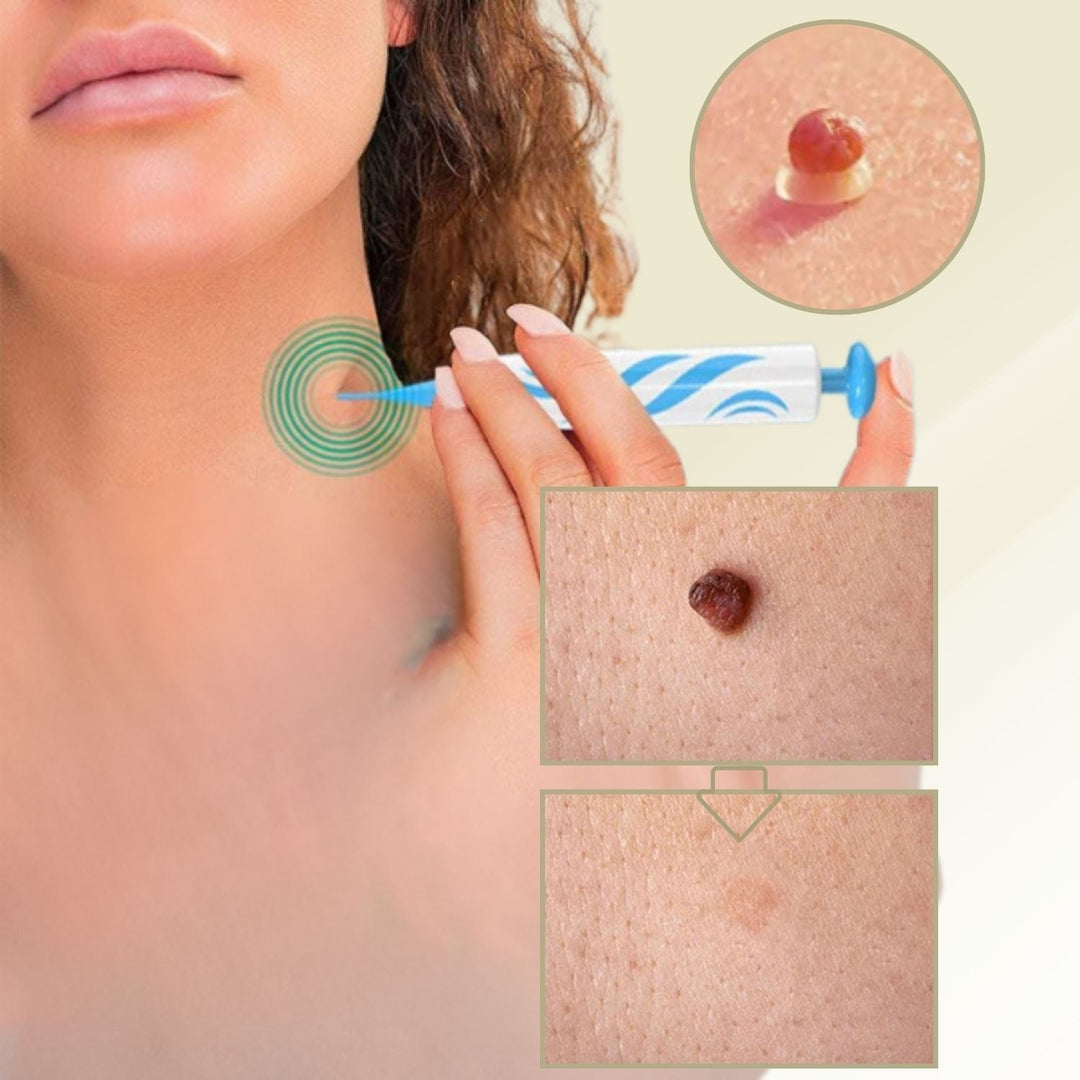 Kalsten | DermaLinx Wart Remover | Pain-Free Removal of Warts & Moles | For Home | Without Surgery
