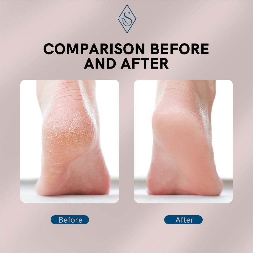 Electric Foot Callus Remover | Kalsten