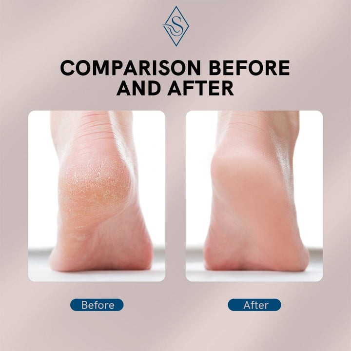 Electric Foot Callus Remover | Kalsten