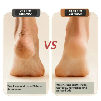 Horn skin removal Soft and light feet | Kalsten