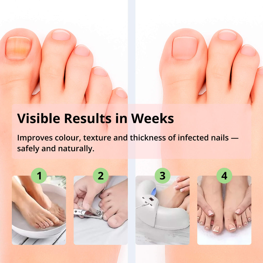 Laser Nail Treatment Device – Red and blue light against nail fungus | Kalsten