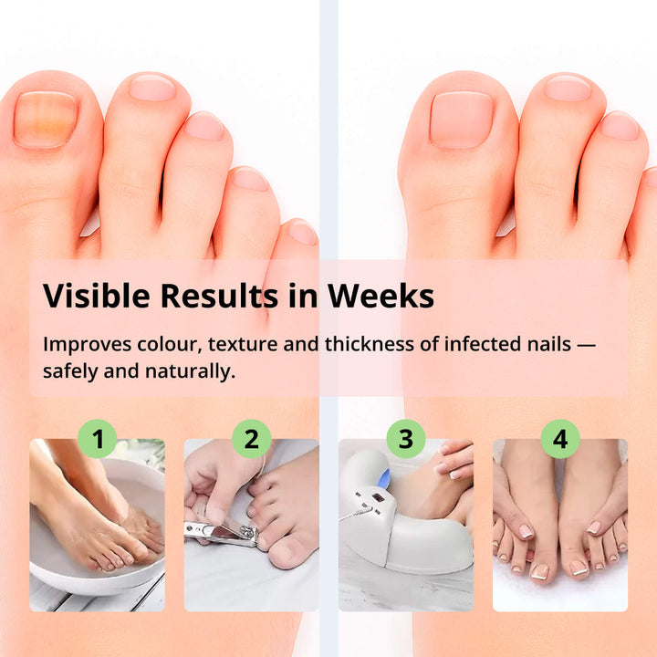 Laser Nail Treatment Device – Red and blue light against nail fungus | Kalsten