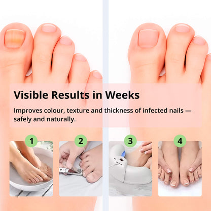 Skanto | Laser Nail Fungus Remover | Advanced Home Treatment with Red & Blue Light for Healthy Nails