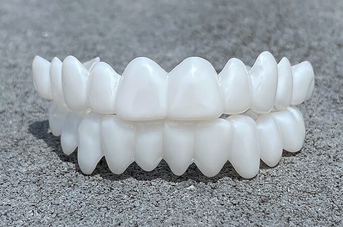 Kalsten | DentAlign Dental Veneers – Natural Fit and Comfort