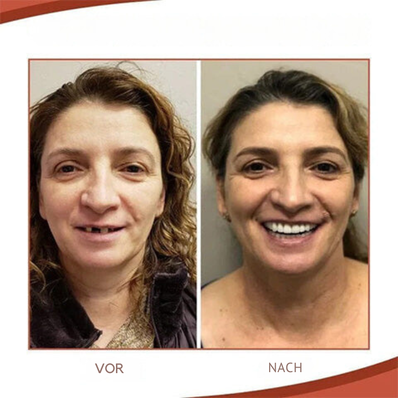 Kalsten | Biocompatible  Prosthesis Set for Pain-Free Fit and Natural Smile
