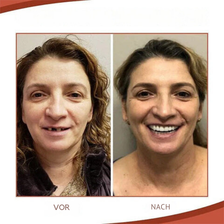 Kalsten | Biocompatible  Prosthesis Set for Pain-Free Fit and Natural Smile