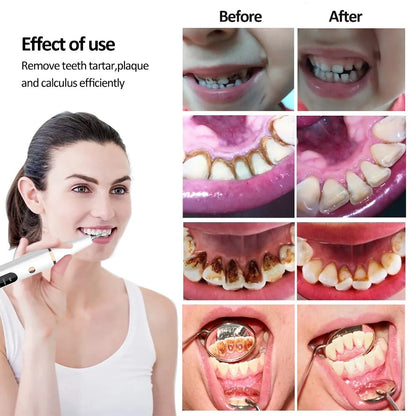 Skanto | Electric Tartar Remover