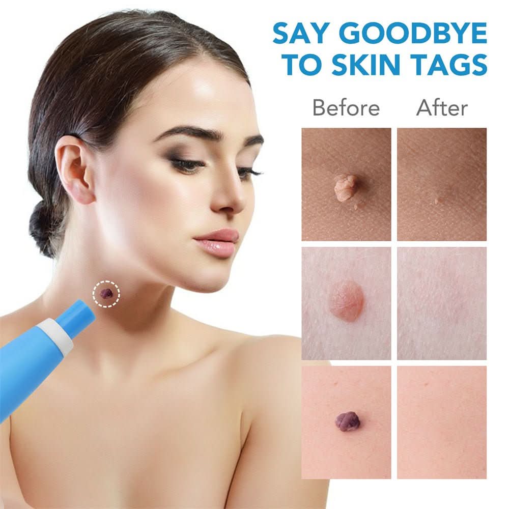 Kalsten | Skin spot remover for warts & skin tags