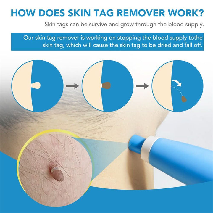 Kalsten | Skin spot remover for warts & skin tags