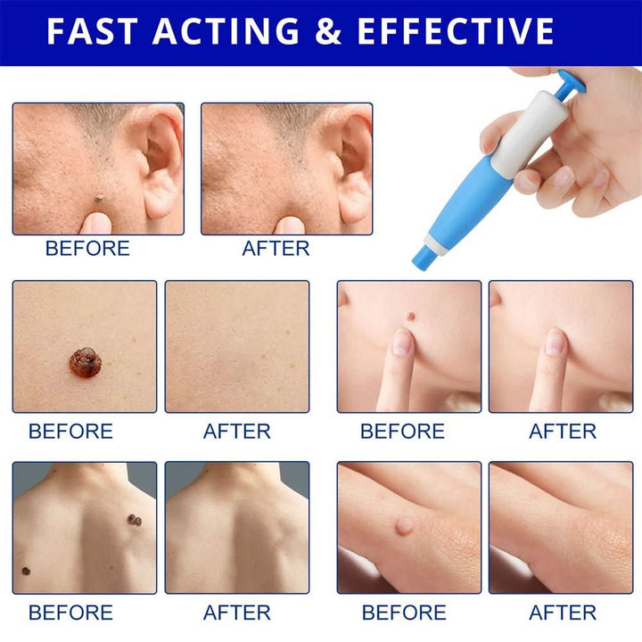 Kalsten | Skin spot remover for warts & skin tags