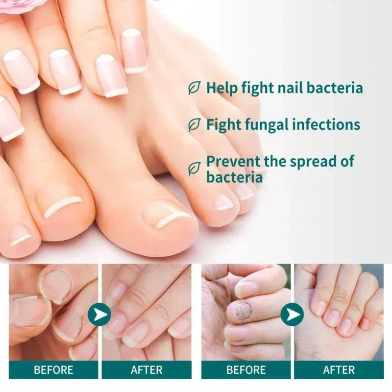 Kalsten | Nail Fungus Defender Serum