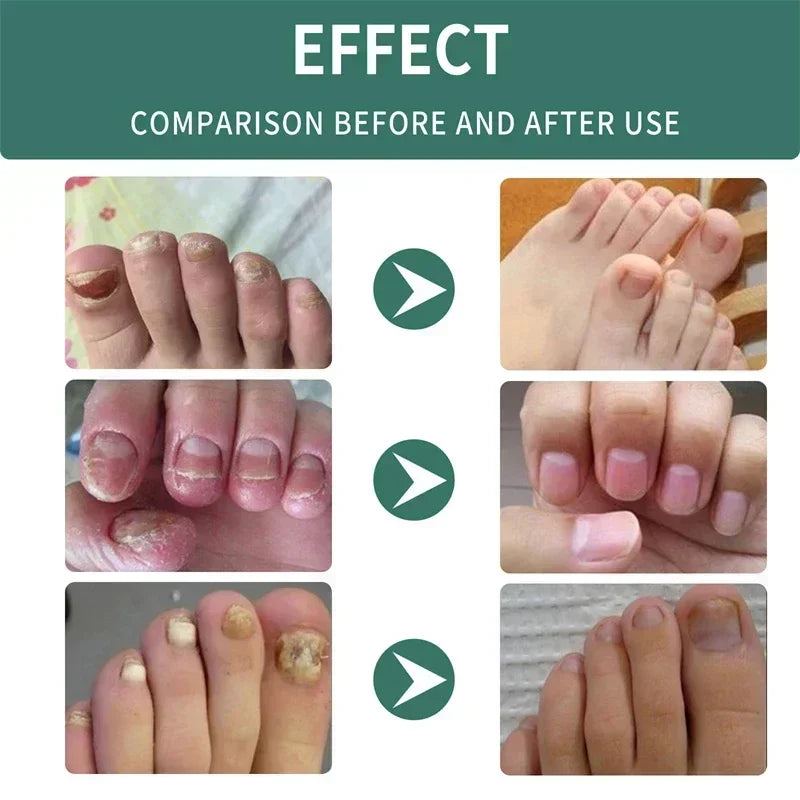 Kalsten | Nail Fungus Defender Serum