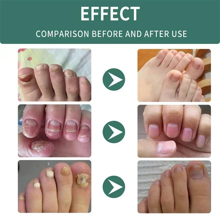 Kalsten | Nail Fungus Defender Serum