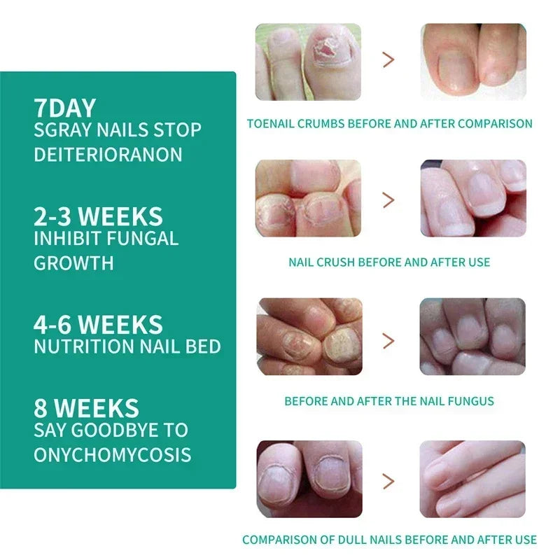 Kalsten | Nail Fungus Defender Serum
