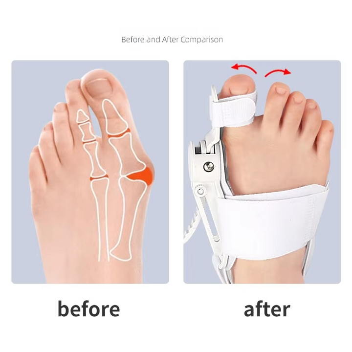 Kalsten | Hallux Valgus Bunion Corrector Toe Separator Foot Alignment Support
