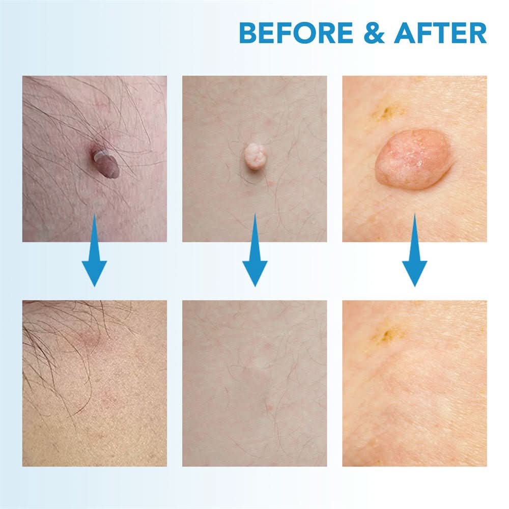 Kalsten | Skin spot remover for warts & skin tags
