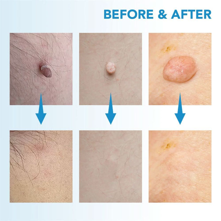 Kalsten | Skin spot remover for warts & skin tags