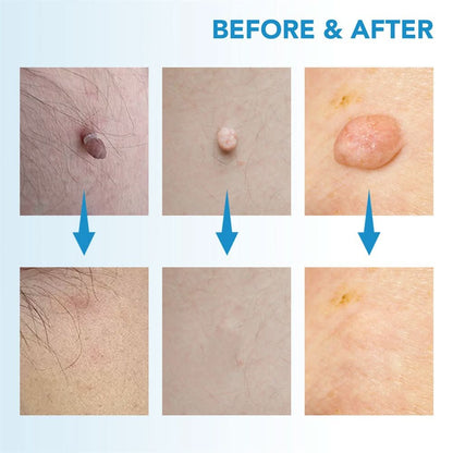 Preparations for the removal of skin spots, warts and skin tags