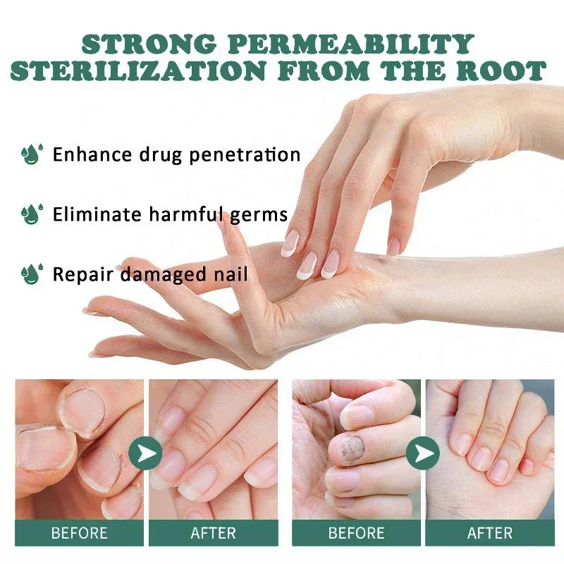 Kalsten | Nail Fungus Defender Serum