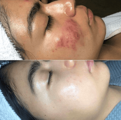 Skanto | Frendorf High-Frequency Skin Therapy