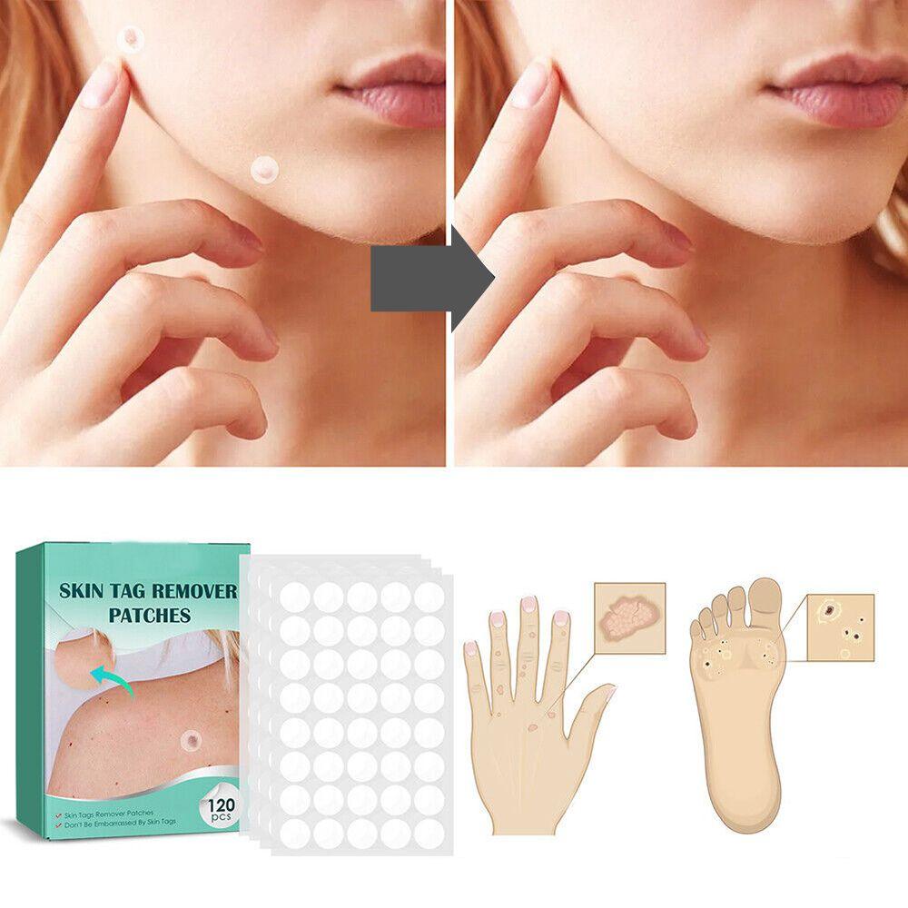 Kalsten | SkinClear - Plaster for the removal of spots and warts