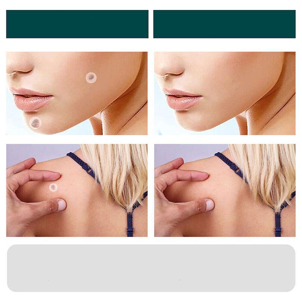 Kalsten | SkinClear - Plaster for the removal of spots and warts
