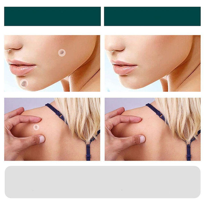 Kalsten | SkinClear - Plaster for the removal of spots and warts