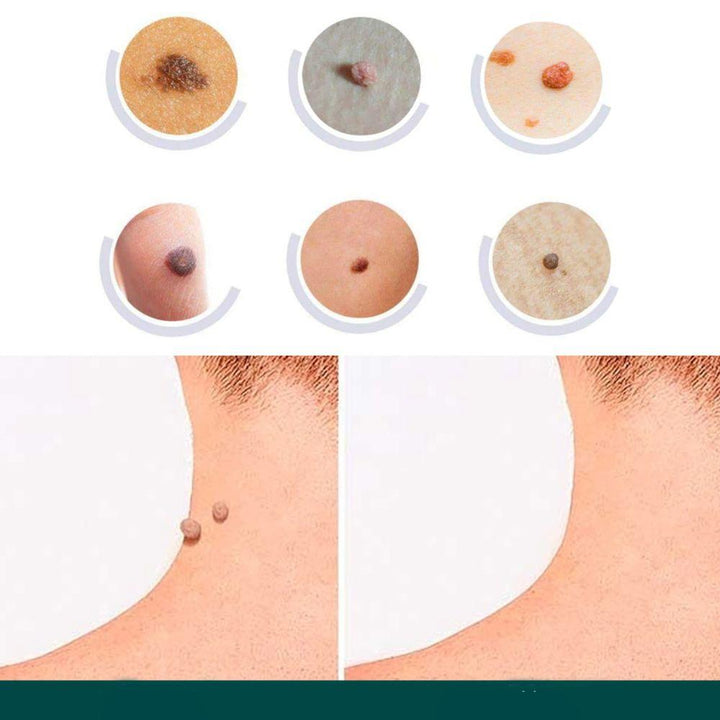 Kalsten | SkinClear - Plaster for the removal of spots and warts