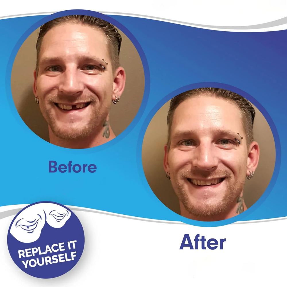 Removable Fillings Tooth Cover Kalsten