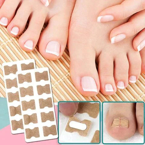 Kalsten | ALIGNSTRIP – Painless Nail Correction Strips for Ingrown & Deformed Nails